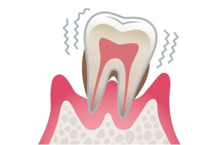 歯周病とは