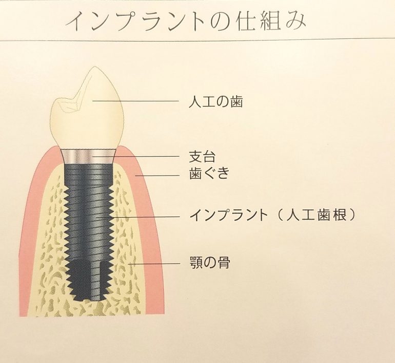 インプラント　部分入れ歯やブリッジ　芦屋川聖栄歯科医院・矯正歯科