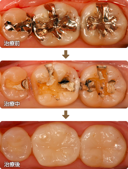 ２次カリエス　銀歯の下が虫歯