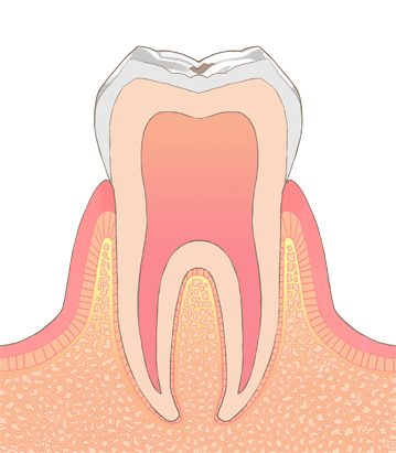初期むし歯（CO　シーオー）