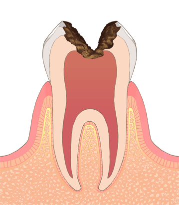 神経まで進んだむし歯（C3　シースリー）