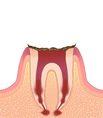歯根だけ残ったむし歯（C4　シーフォー）