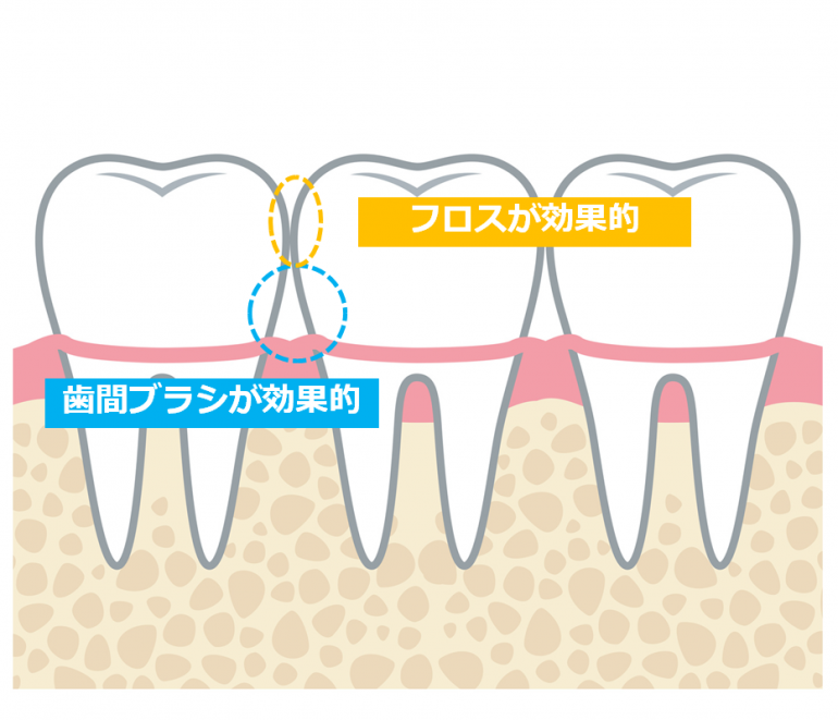 フロスが効果的　歯間ブラシが効果的