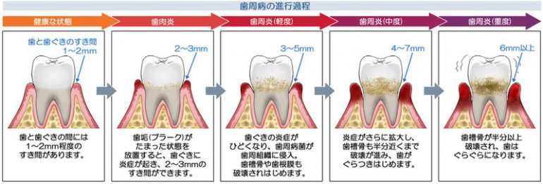 歯周病の進行過程