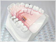歯科技工士　インレー　