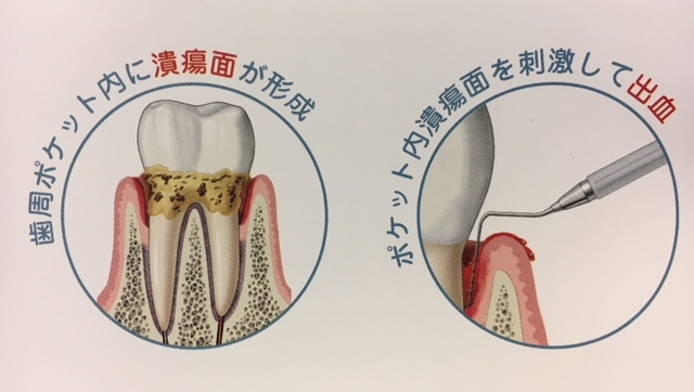 歯周病